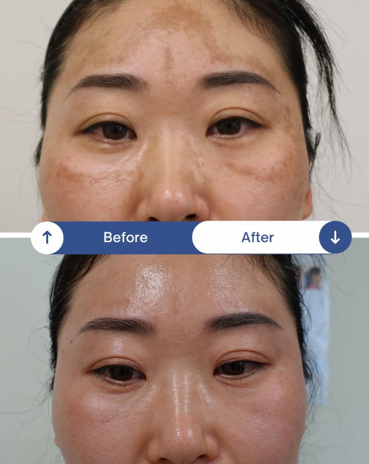 🌸 Melasma in Asian Skin: Why It Gets Worse in Autumn; How to Treat It Safely