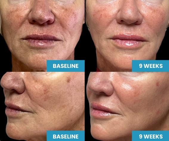 The Glow-Up You've Never Heard Of: Bio Filler (PRP Gel) Is Here