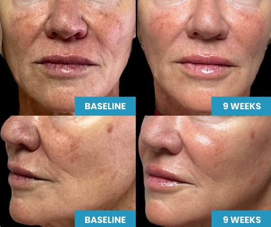 The Glow-Up You've Never Heard Of: Bio Filler (PRP Gel) Is Here