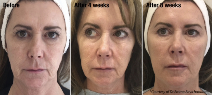 Bioremodelling treatment for glowing, youthful skin