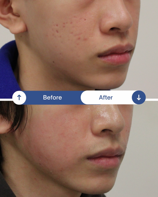 ✨ Acne Scar Treatment Melbourne: CO₂ Laser and Other Treatment Options Explained