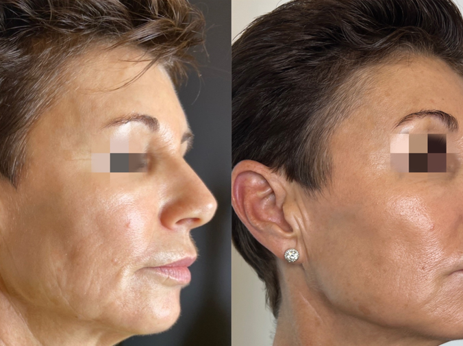 ✨ What is Gouri? The Future of Skin Rejuvenation – Now at HEMAC Skin Clinic