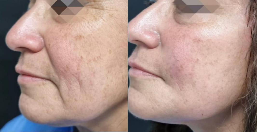 Lenisna (Juvelook): What Is This Collagen-Stimulating Treatment Everyone Is Talking About in Melbourne?
