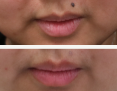 Mole Removal Melbourne | When Should You Get a Mole Checked or Removed?